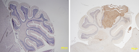 Dans l'oeil du médulloblastome