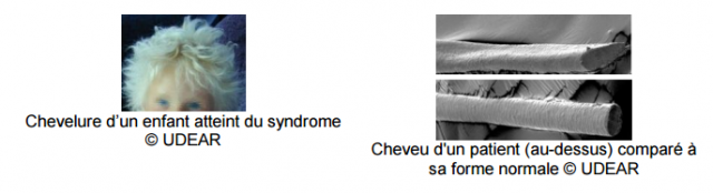 L'origine du syndrome des cheveux incoiffables identifiée