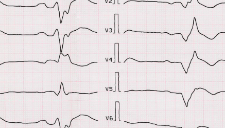 Partager Infarctus du myocarde : prévenir la récidive