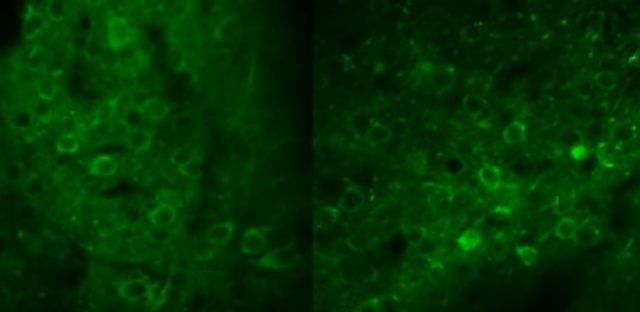 Comment la nicotine agit sur le cerveau des schizophrènes