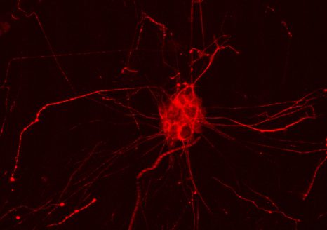 Maladie d’Alzheimer: des mutations rares augmentent significativement le risque de la développer