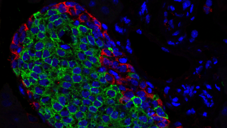 Syndrome de surcroissance: vers une meilleure compréhension des mutations du gène PIK3CA