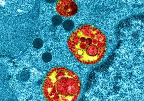Covid-19: 3ème cause de décès en France en 2020, baisse des autres grandes causes de décès