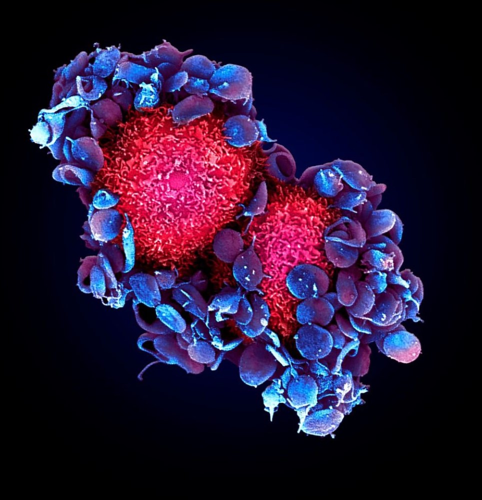 Propagation des cancers: cibler les plaquettes pour contrer les métastases ?