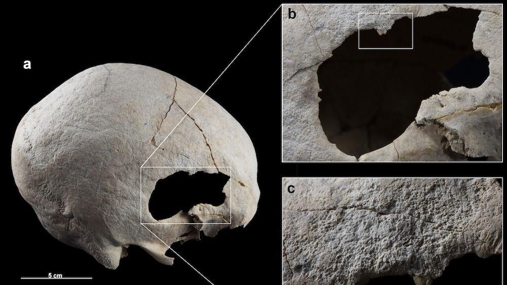 Cette femme a survécu à deux opérations chirurgicales crâniennes, il y a 4500 ans