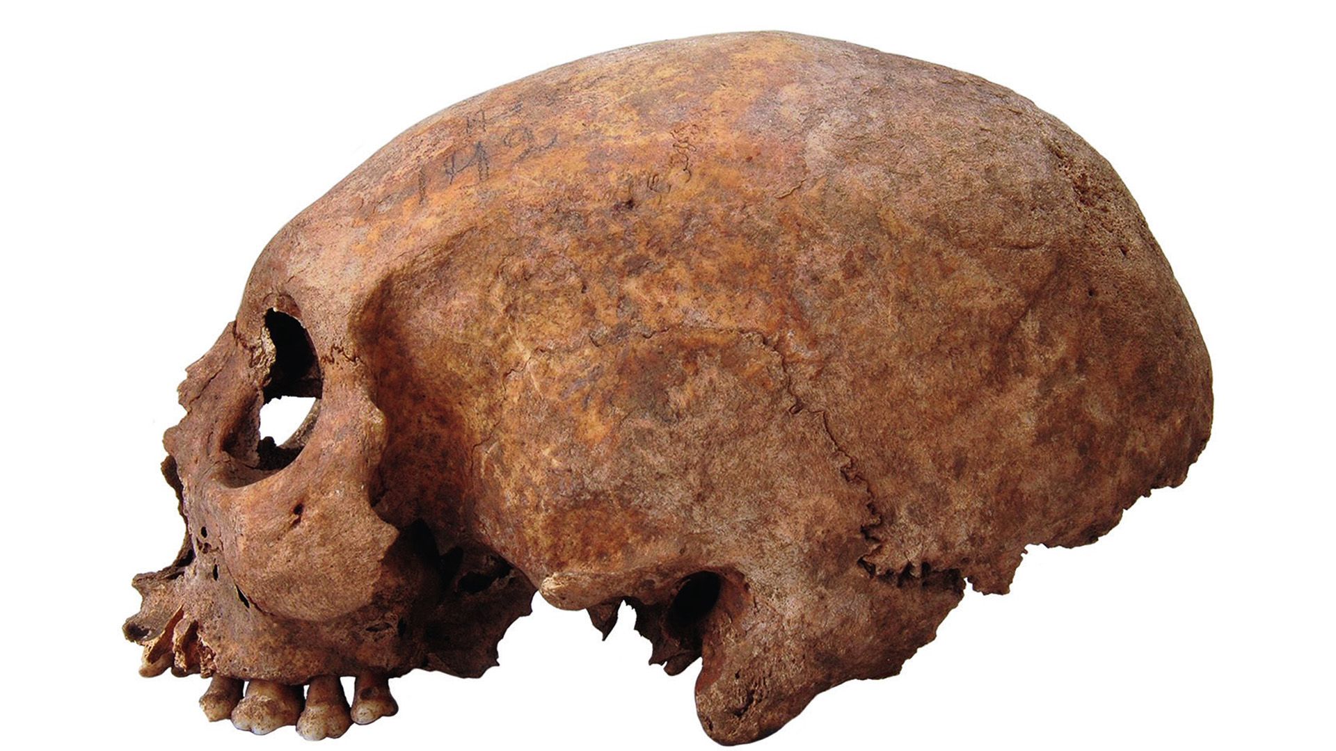 The secret of the conical skulls and filed teeth of the Vikings