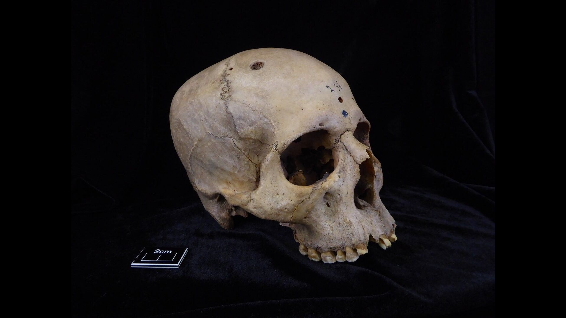 Evidence of surgical cancer treatments in ancient Egypt over 4000 years ago