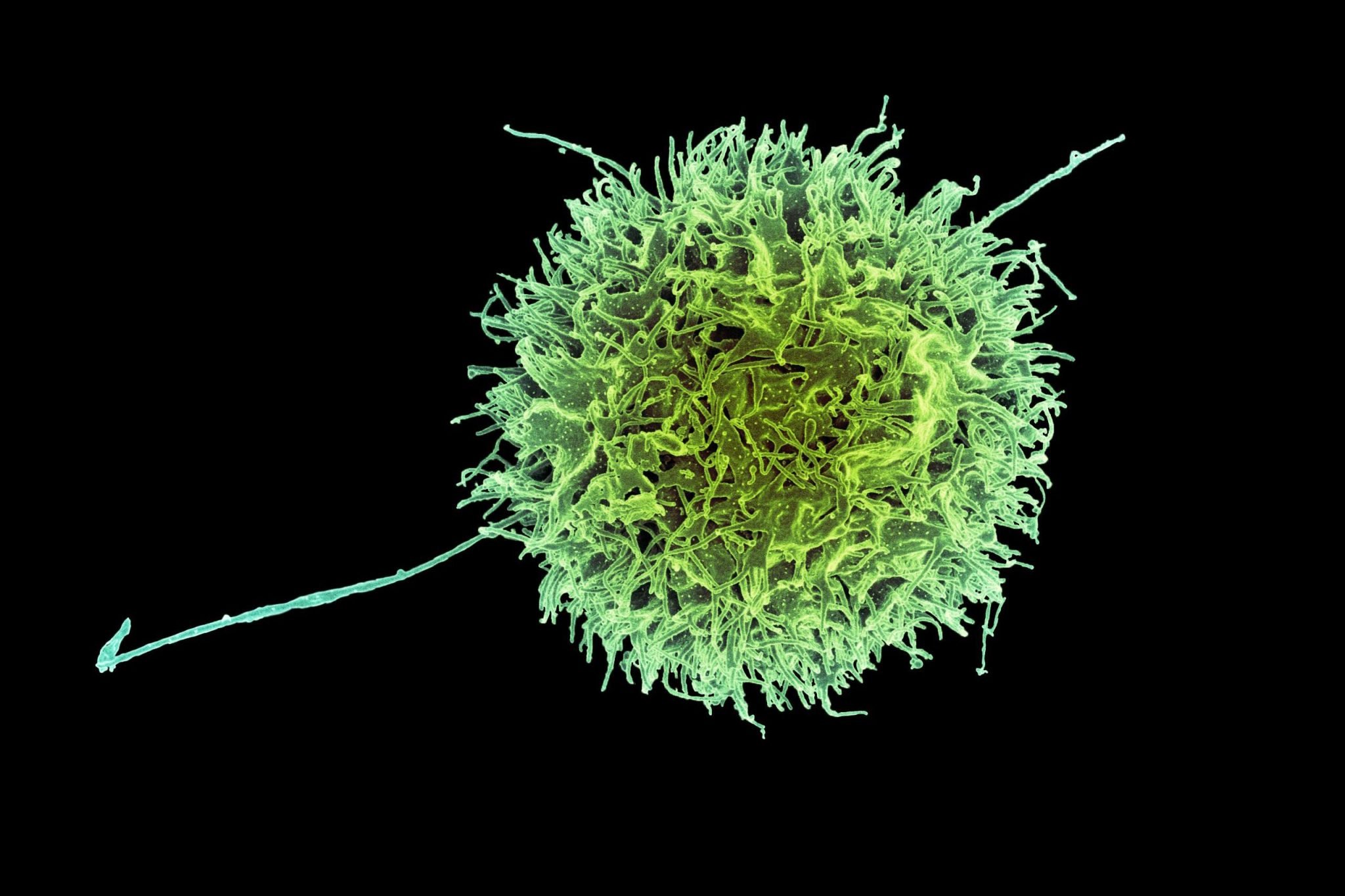 💊 Cancer: this ready-to-use therapy promises to eliminate tumors