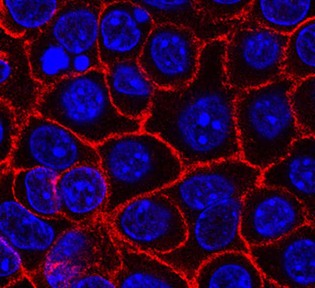 Cancer: faire revenir les cellules cancéreuses dans le droit chemin