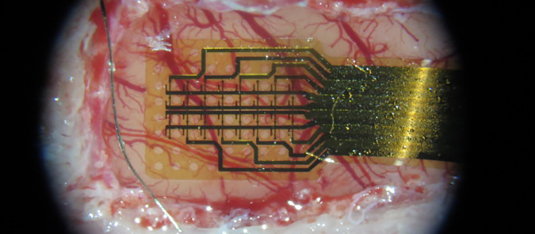 Braincom: retrouver la parole grâce à des implants corticaux