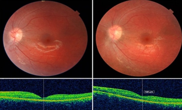Une dégénérescence de la vue et du cœur stoppée