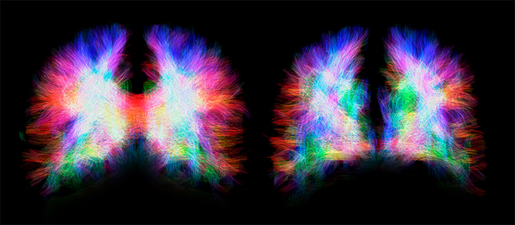 Une malformation illustre l’incroyable plasticité du cerveau