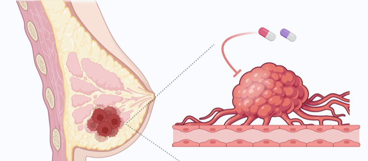 Vaincre les résistances au traitement du cancer du sein