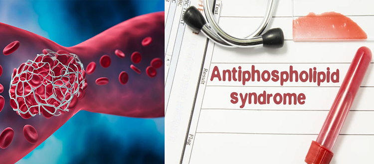 Détecter les anticorps causant thromboses et fausses couches