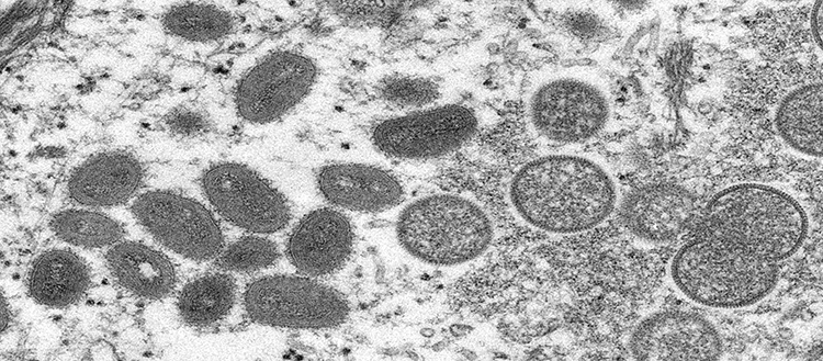 Variole du singe: premier séquençage génomique en Suisse
