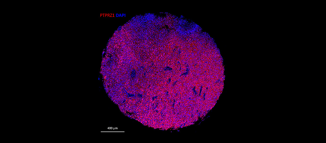 Genetically modified cells target tumors