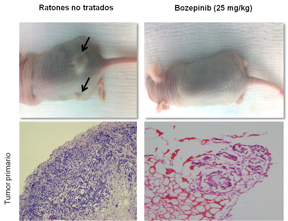 Cancer: efficacité d'un médicament contre les cellules souches