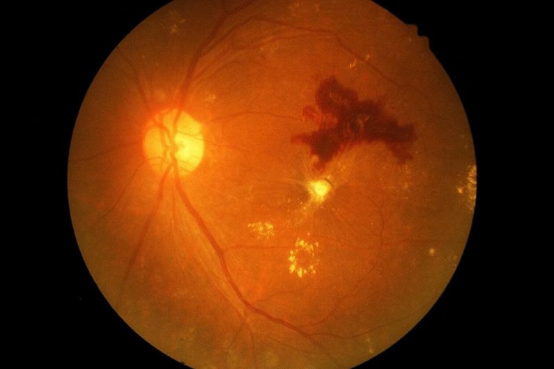 Découverte d'un nouveau médicament pour la rétinopathie diabétique