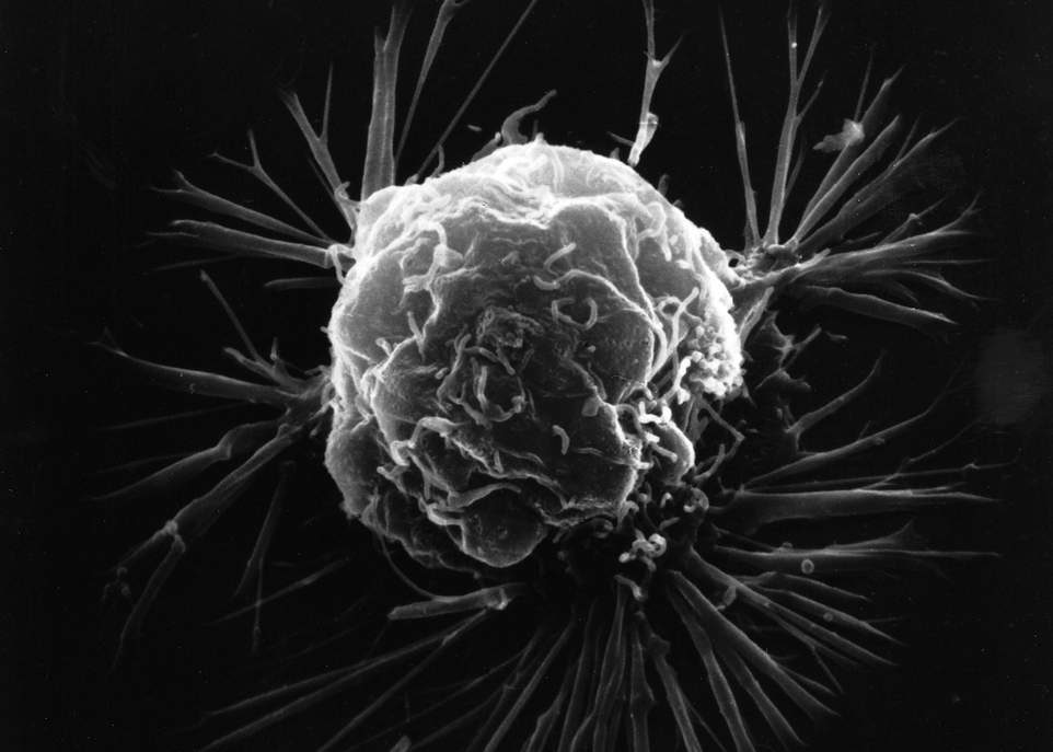 Cancer: pour éviter des traitements inefficaces