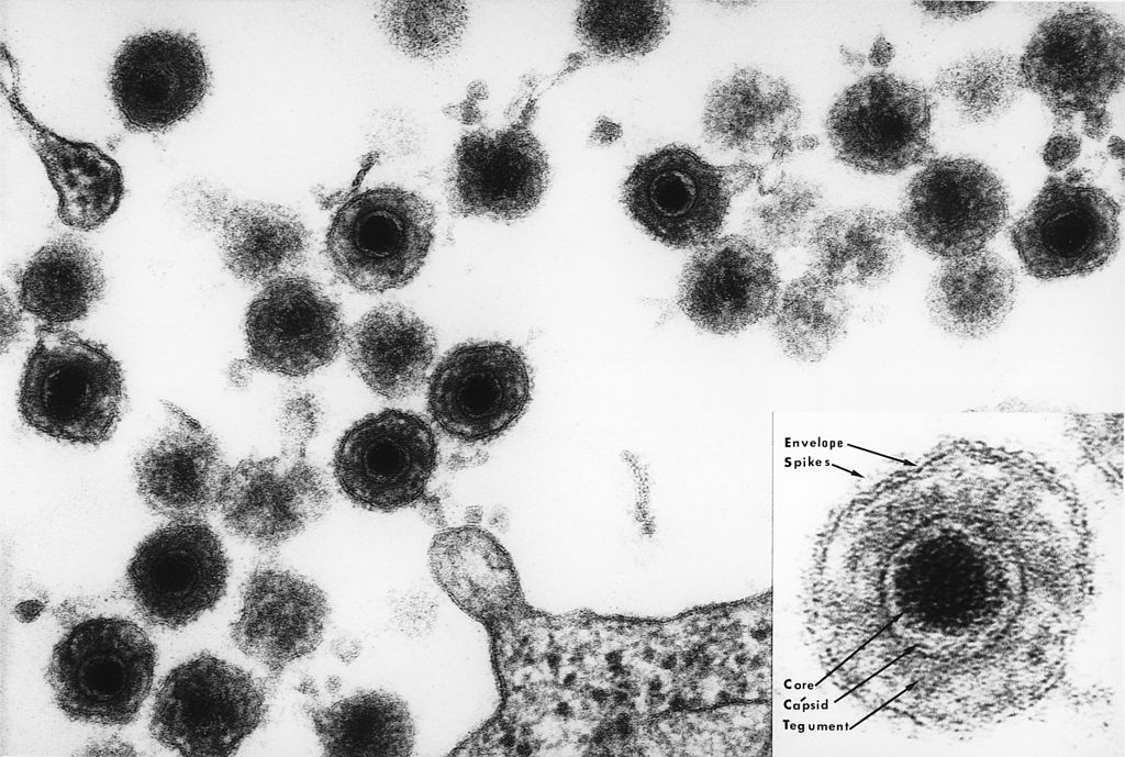 HHV-6: le virus qui se cache dans notre génome