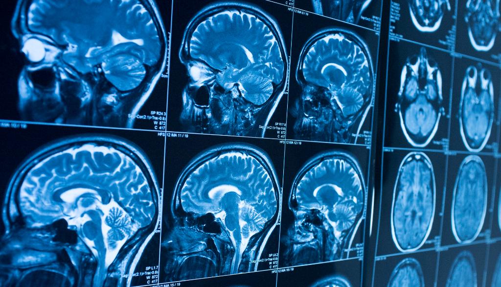 L'obésité liée à des altérations d'une zone du cerveau