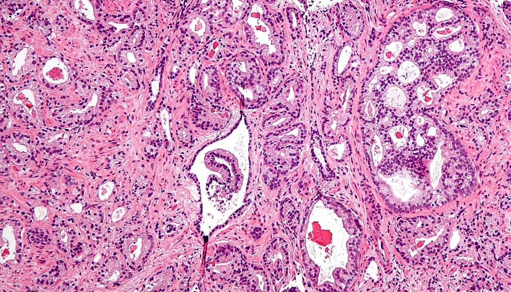 Cancer de la prostate: des avancées du côté de la résistance aux traitements hormonaux