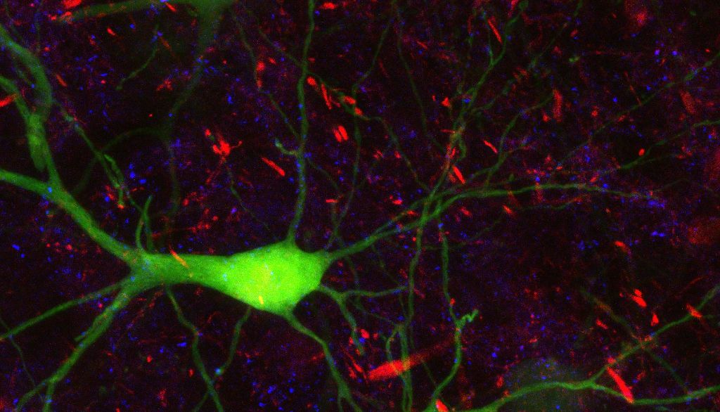 Découverte: cette protéine influence la progression de l'alzheimer
