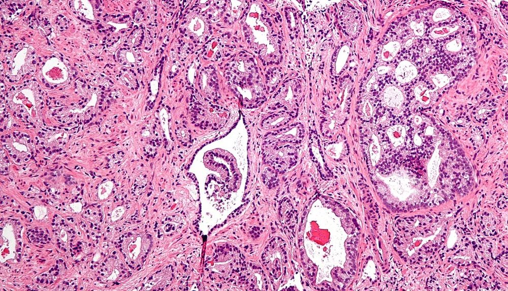 Discovery: these breast cancer drugs effective against prostate cancer