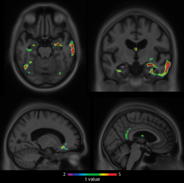 L'incapacité de reconnaître ses propres problèmes de mémoire: signe prédictif de la maladie d'Alzheimer