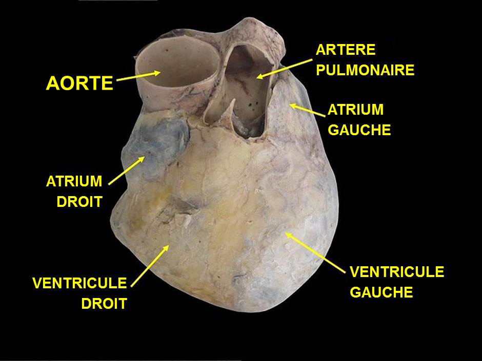 Les minéraux qui bloquent les valvules cardiaques diffèrent chez l’homme et la femme